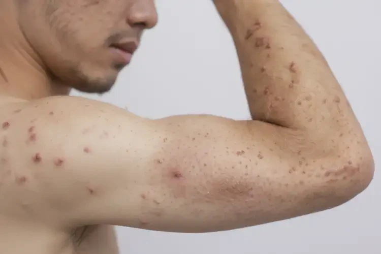 男生手臂上長(zhǎng)濕疹可不可以根治(圖4)