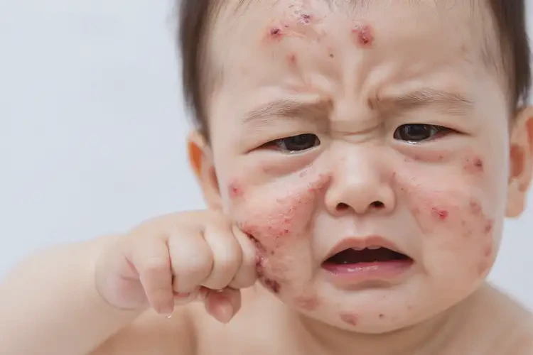 嬰兒面部有濕疹不管它會自己痊愈嗎(圖4)