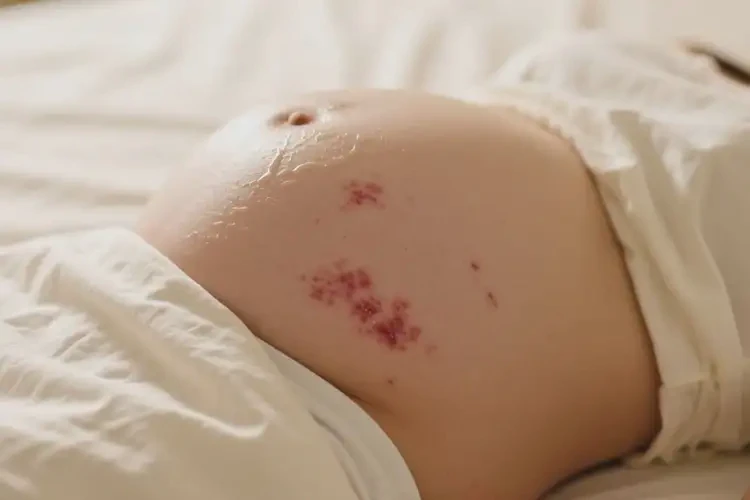 產(chǎn)婦屁股起濕疹可不可以根治(圖2)