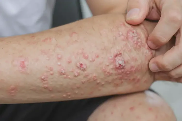 青少年手臂偶爾起濕疹可不可以根治(圖4)