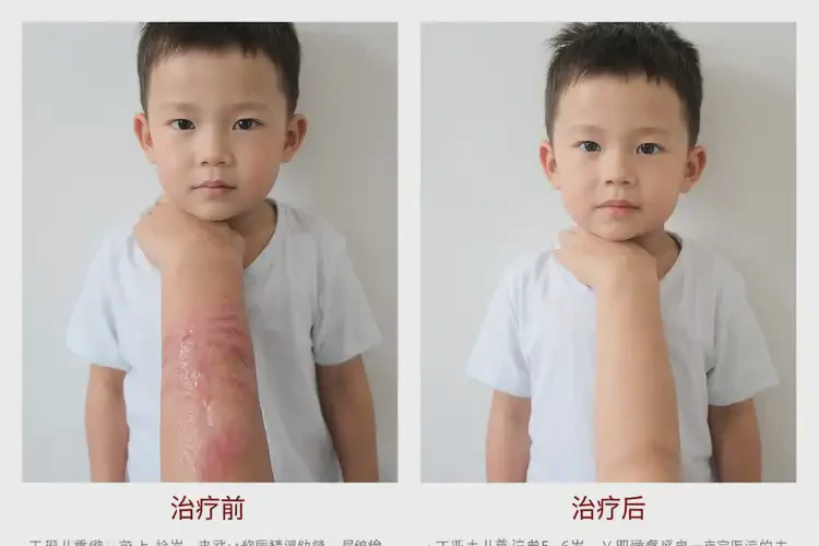 小孩臉上經(jīng)常長濕疹可以治好嗎(圖4)