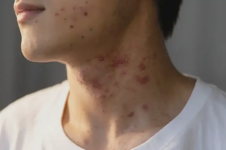 男生脖子偶爾起濕疹可不可以根治(圖4)