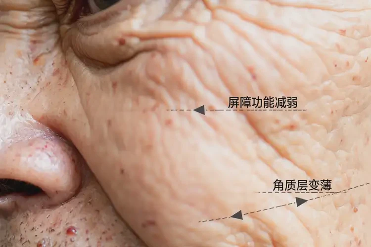 老年人全身容易起濕疹能靠自己自愈嗎(圖4)