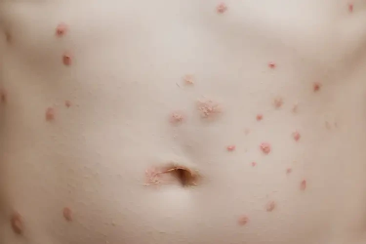 少儿肚子出现湿疹能靠自己自愈吗(图4)