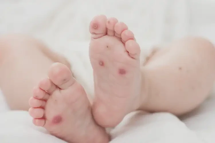 寶寶腳上容易起濕疹可以徹底自愈嗎(圖4)