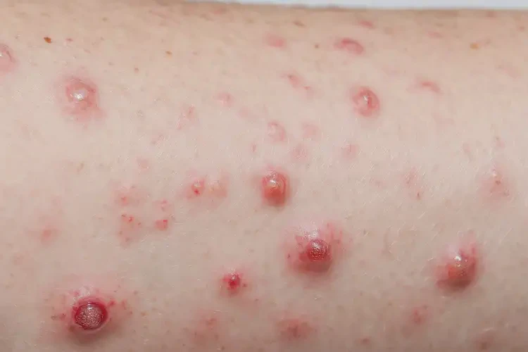 女生大腿出濕疹不管它會(huì)自己自愈嗎(圖4)