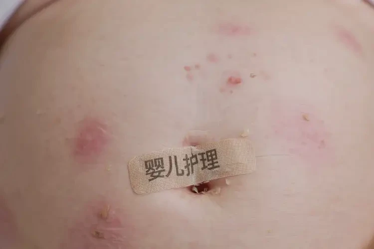 新生兒肚子上長濕疹可不可以根治(圖4)