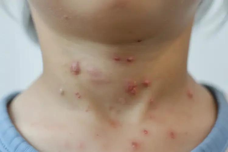 少兒脖子上容易長濕疹可以徹底自愈嗎(圖4)