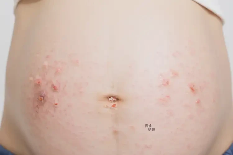 孕婦肚子經(jīng)常長(zhǎng)濕疹可以治好嗎(圖4)