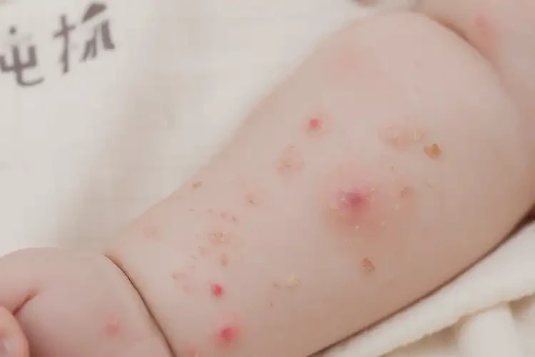 孩子四肢出濕疹能靠自己自愈嗎(圖3)