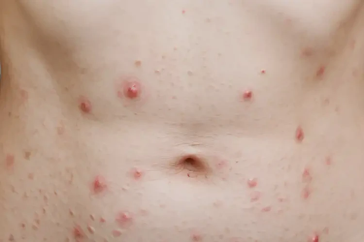 女性肚子容易起湿疹可以治好吗(图4)