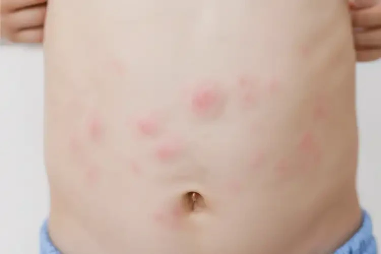 兒童肚子有濕疹能靠自己自愈嗎(圖4)