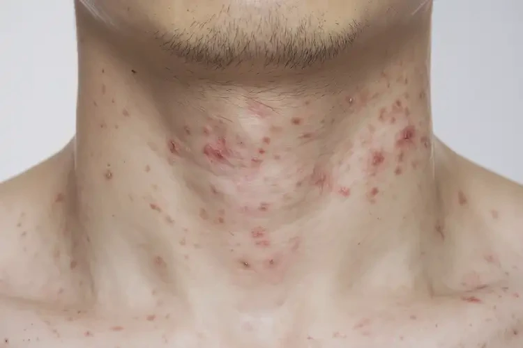 青年人脖子经常长湿疹可不可以根治(图4)