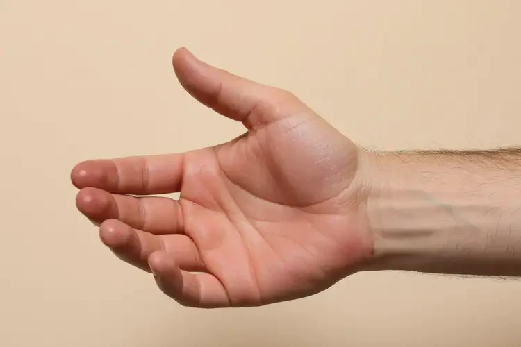 男性手上出現(xiàn)濕疹可以治好嗎(圖4)