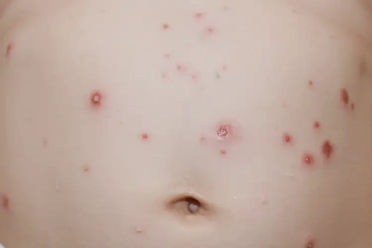 孩子肚子出現濕疹可以治好嗎(圖4)