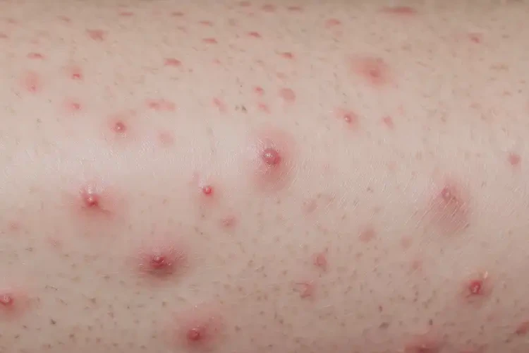 女性小腿容易長濕疹可以治好嗎(圖4)