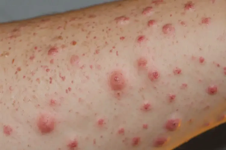 男人手臂长湿疹可不可以根治(图4)