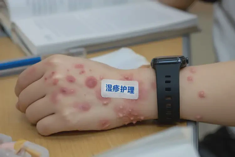 中學生手上出現(xiàn)濕疹能夠徹底治愈嗎(圖4)