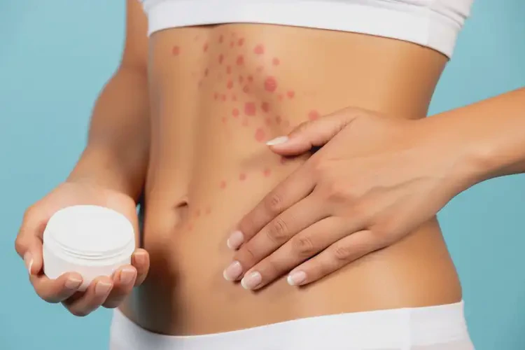 女生肚子容易起濕疹可不可以根治(圖3)