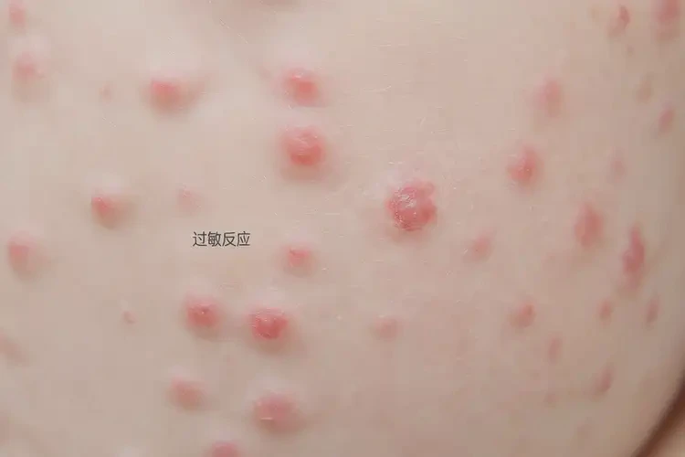 寶寶屁股有濕疹可以治好嗎(圖4)