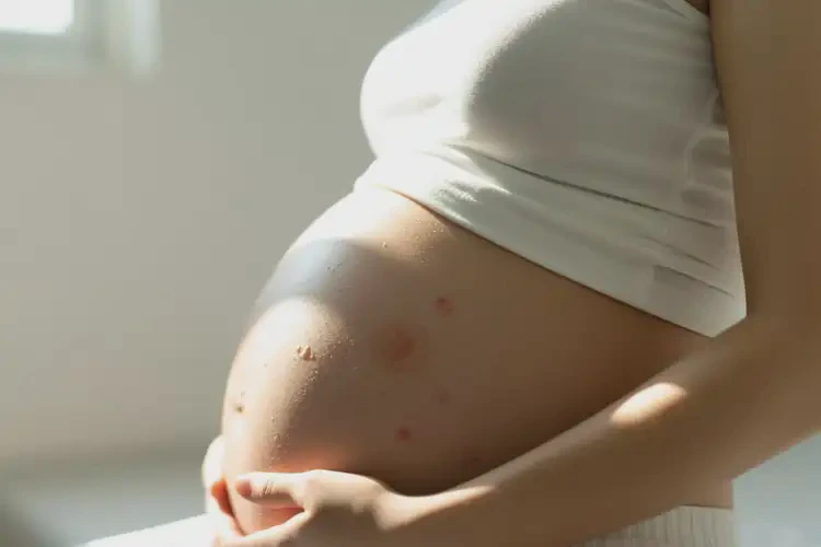 孕婦肚子上偶爾起濕疹可以治好嗎(圖3)