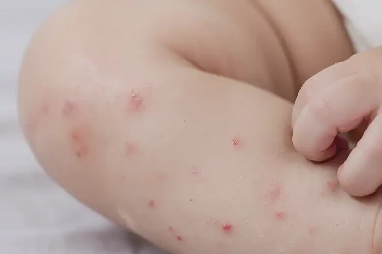 嬰幼兒小腿偶爾起濕疹能徹底自愈嗎(圖4)