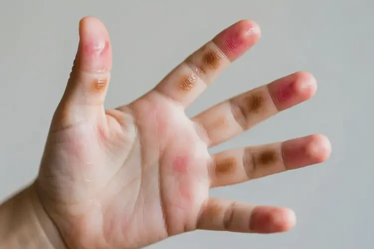 少兒手上長濕疹可以治好嗎(圖3)