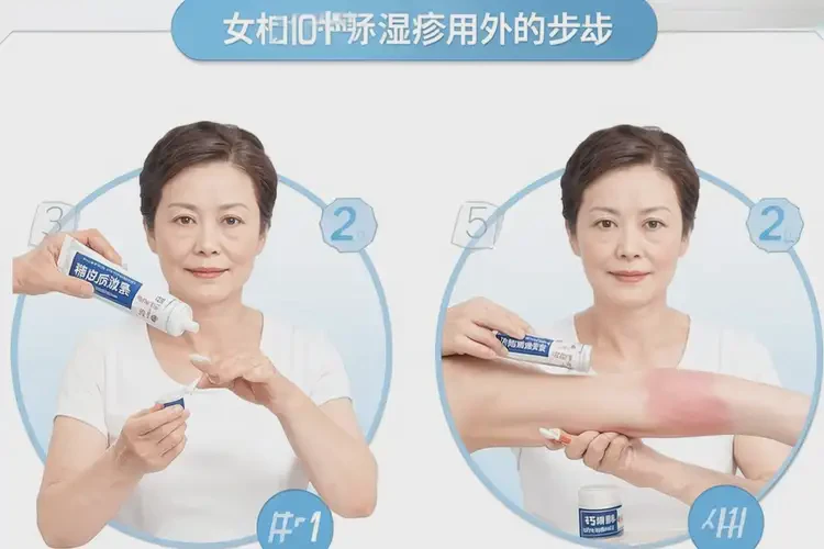 女性四肢有濕疹可不可以根治(圖4)