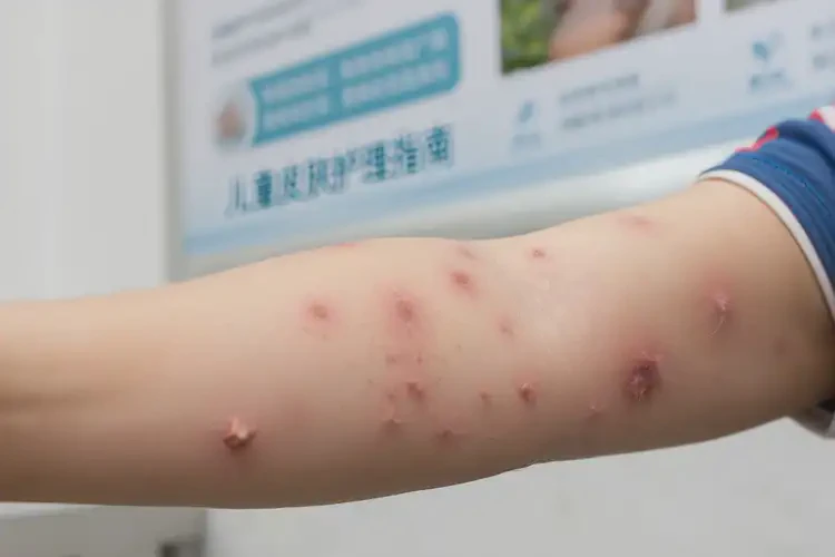 少兒身上出現(xiàn)濕疹可以治好嗎(圖4)