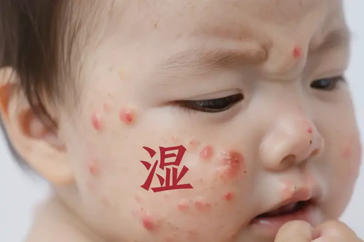 婴幼儿脸上容易起湿疹可不可以根治(图4)