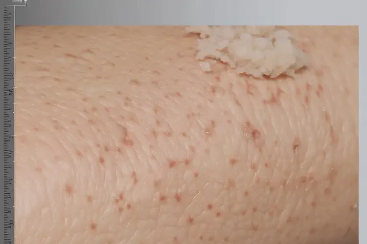 孩子四肢出濕疹能靠自己自愈嗎(圖2)