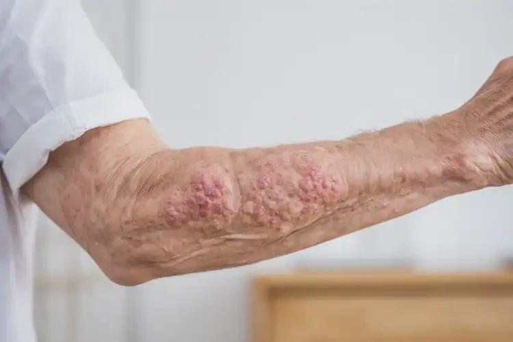 老人手臂偶爾長(zhǎng)濕疹可以治好嗎(圖4)