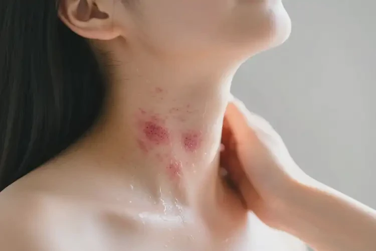 產(chǎn)婦脖子出現(xiàn)濕疹可不可以根治(圖4)