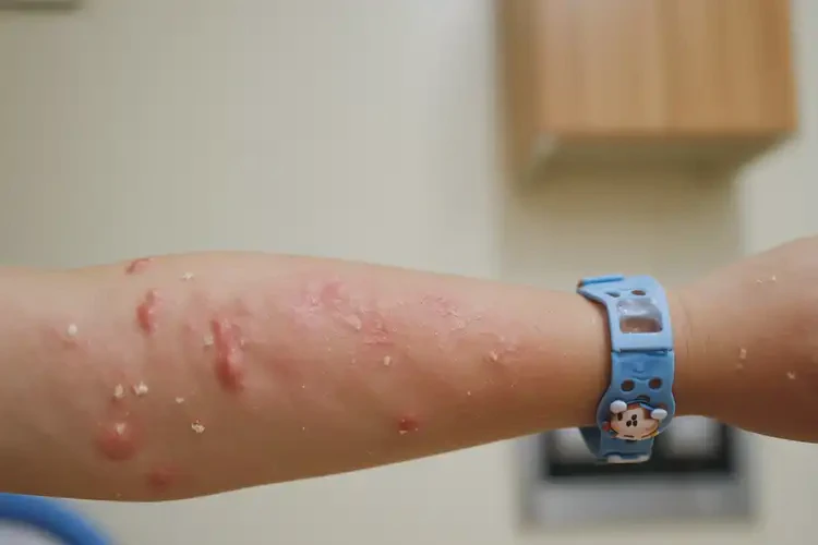 小学生手臂有湿疹可不可以彻底自愈(图3)