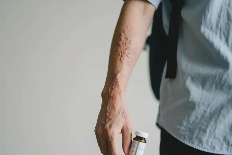 大學(xué)生手臂有濕疹可不可以根治(圖2)