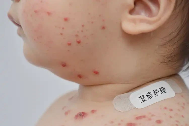 小儿脖子上经常起湿疹不管它会自己自愈吗(图4)