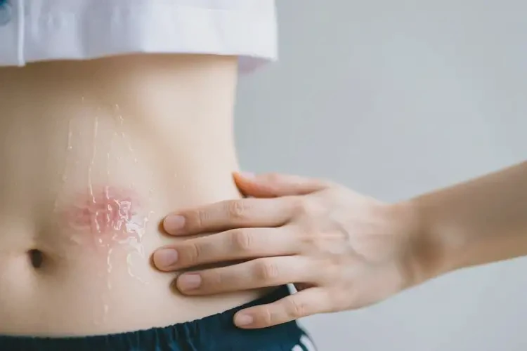 大学生肚子上出现湿疹可不可以根治(图3)