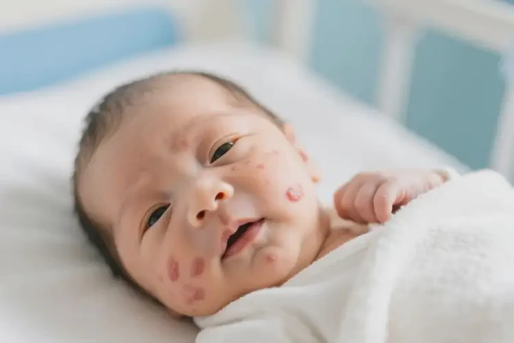 新生兒面部經(jīng)常長(zhǎng)濕疹可不可以根治(圖4)