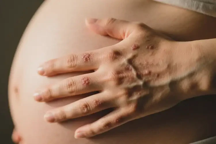 產(chǎn)婦四肢偶爾長濕疹可不可以根治(圖4)