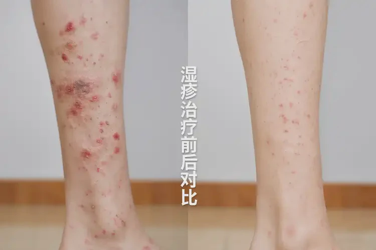 女生小腿上長濕疹可不可以根治(圖1)