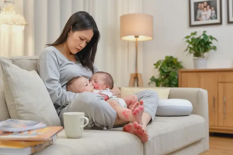 哺乳期媽媽腳上偶爾長濕疹可不可以根治(圖1)