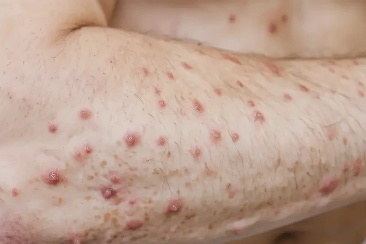 青年人手臂上經(jīng)常起濕疹能不能徹底自愈(圖4)