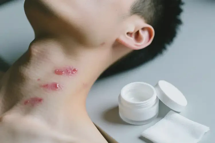 男性脖子偶爾起濕疹可以治好嗎(圖1)