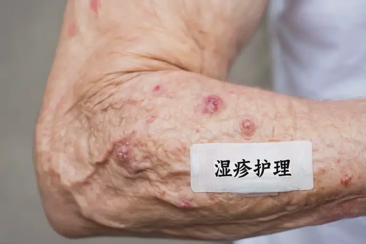 老年人手臂上起濕疹可不可以根治(圖4)