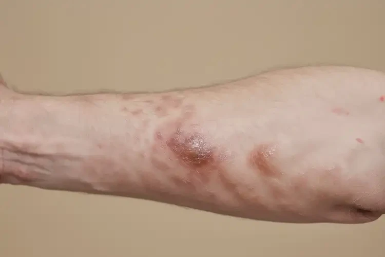 大學(xué)生脖子上出現(xiàn)濕疹不管它會(huì)自己自愈嗎(圖3)