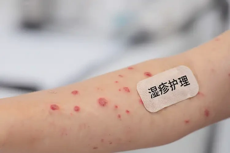 小兒手臂容易長(zhǎng)濕疹能靠自己自愈嗎(圖4)