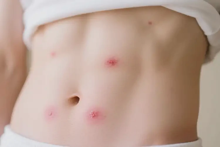 男生肚子偶尔长湿疹可不可以根治(图3)