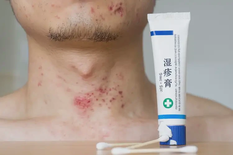 青年人脖子上偶爾長(zhǎng)濕疹可不可以根治(圖4)