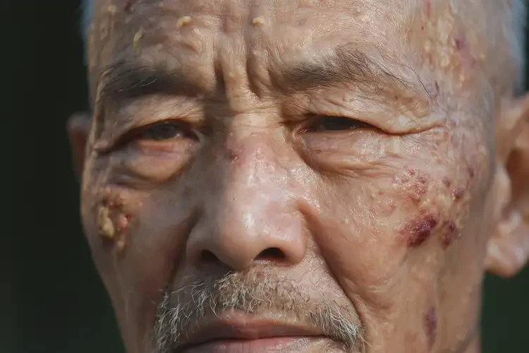 老人臉上有濕疹可以治好嗎(圖4)