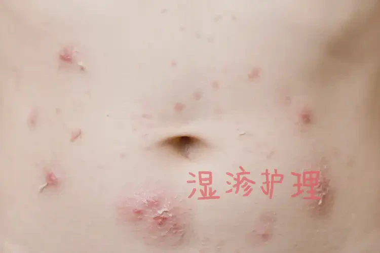 兒童肚子出濕疹可以治好嗎(圖4)